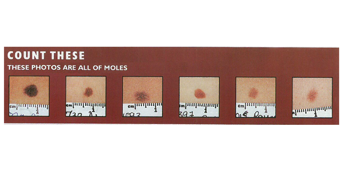 Moles correct size chart, showing various different mole types