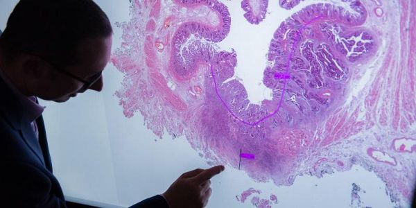New drug shows promise in slowing growth of bowel cancer