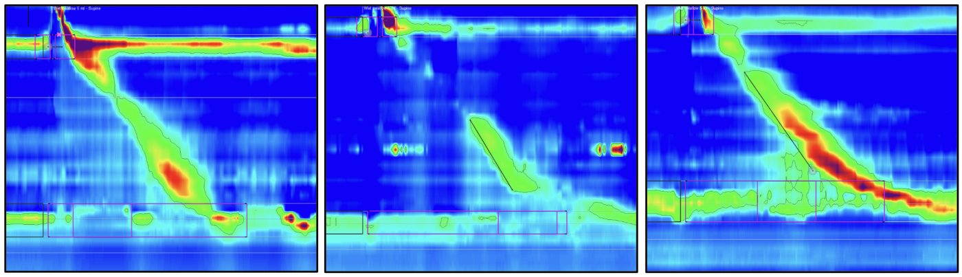 Manometry Pics