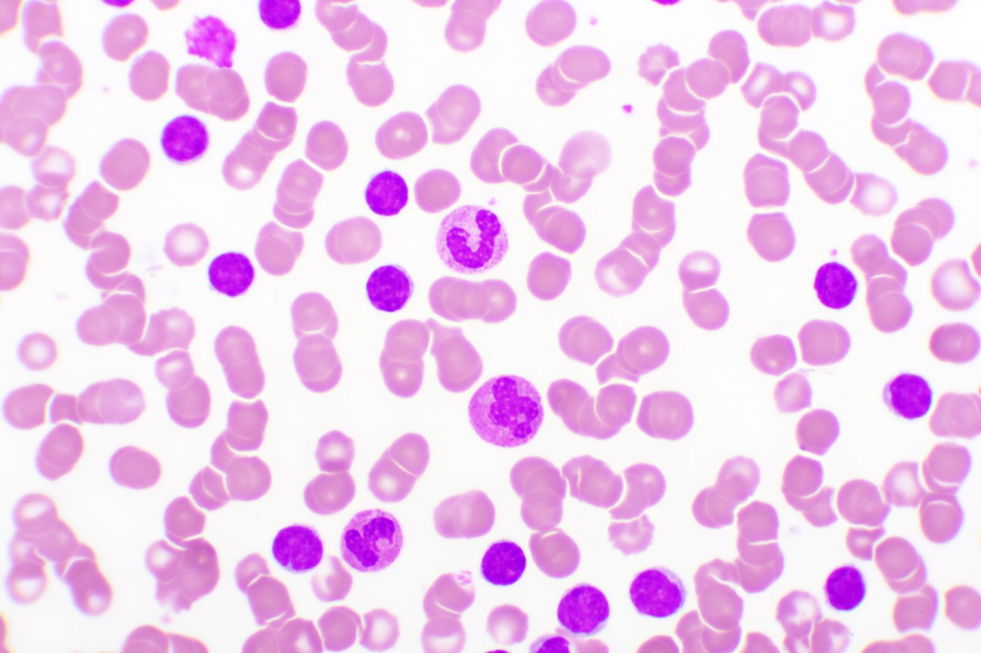 Chronic Lymphocytic Leukemia microscope analysis