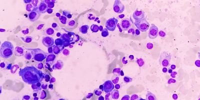 A bone marrow slide showing myeloma cells.