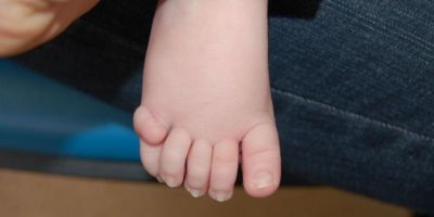 A child's foot. On top of the knuckle of the smallest toe, there's a skin-coloured growth.