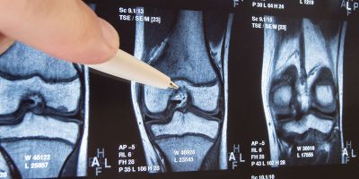 Knee joint x-ray or MRI representing Leeds Institute of Rheumatic and Musculoskeletal Medicine