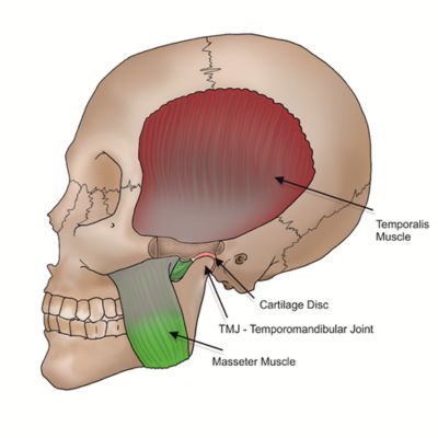 Image of skull with notes to the temporalis muscle at the temple, cartilage disk, TMJ Temporomandibular Joint and Masseter Muscle on the jaw.