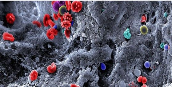 Thrombosis