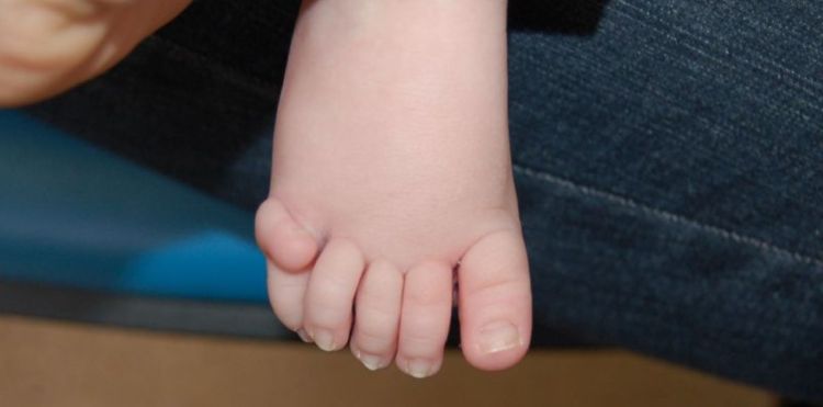 Rare disorder causing extra fingers and toes identified