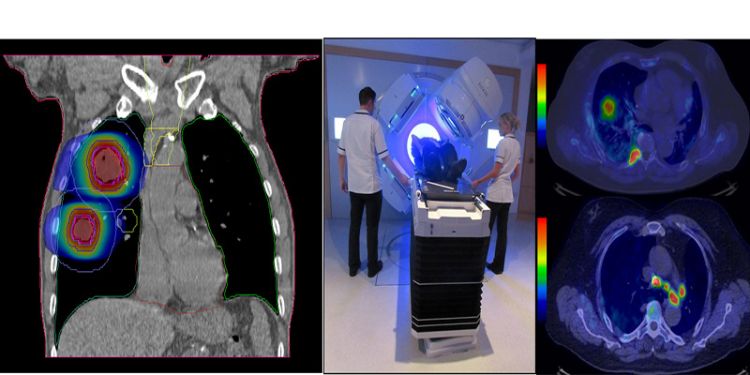 A radiotherapy research collage of images, left to right: a PET CT scan image of lungs, a patient undergoing treatment, a PET CT scan image of lungs from above