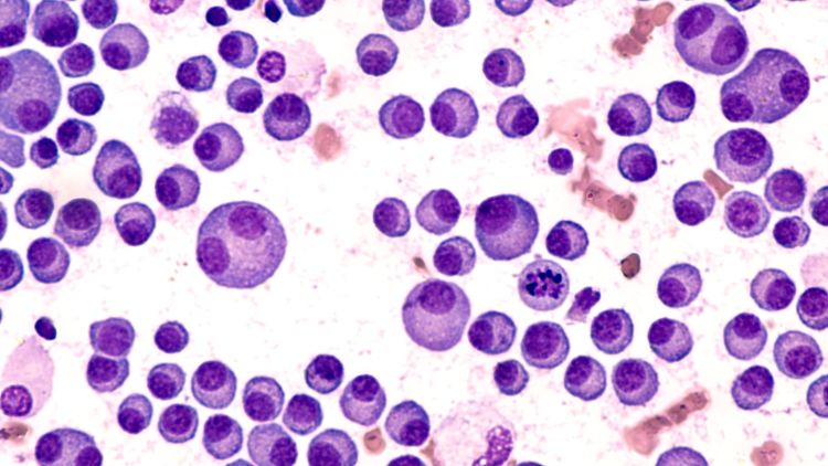 Novel target could be important for multiple myeloma therapy development