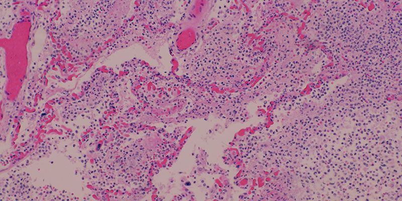 Micrograph of human lung tissue with pneumonia imagge representing Immunity & Inflammation