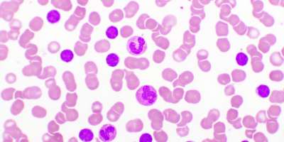Chronic Lymphocytic Leukemia microscope analysis