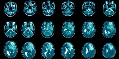 A human brain scan showing repeated images of a brain tumour
