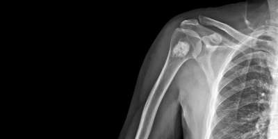 An x-ray showing the shoulder and arm