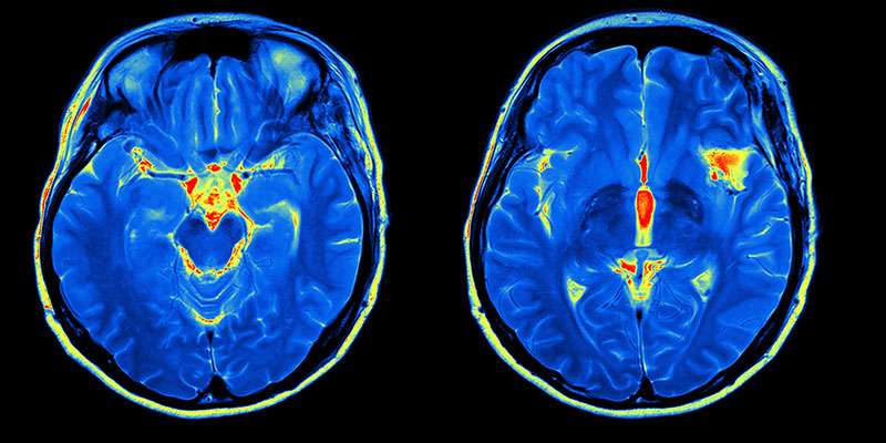 Brain scan highlighting cognitive neuroimaging